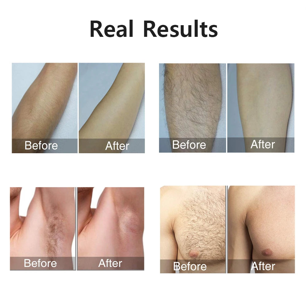 Painless IPL Laser Epilator